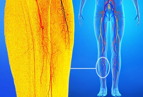 Peripheral artery disease causes cramps in the lower legs.