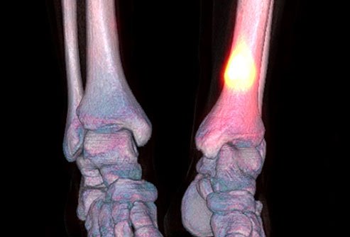Stress fractures are a type of overuse injury.  