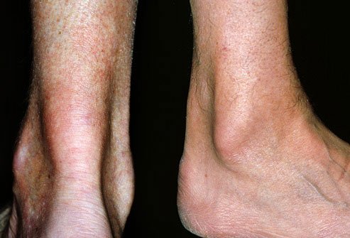 Tendinitis is one potential cause of leg pain.