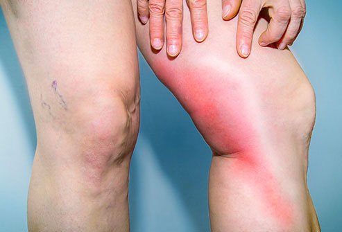 DVT may cause pain and redness in the affected leg.