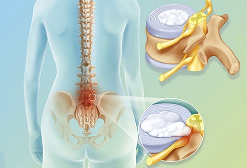 A pinched sciatic nerve, or sciatica, may cause leg pain.