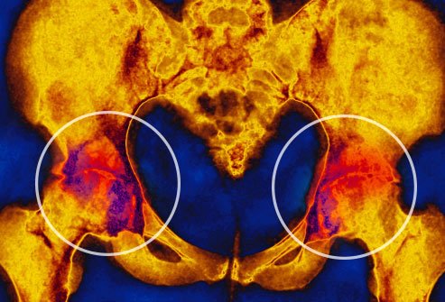 An inflamed arthritic joint aches.