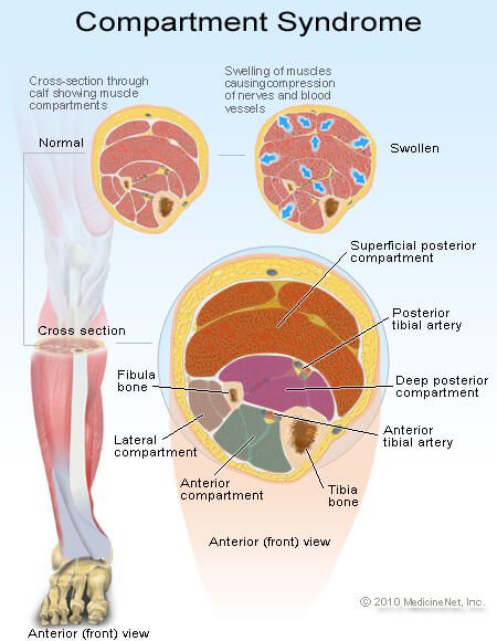 Picture of Compartment Syndrome