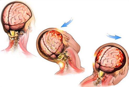 A concussion is defined as a blow to the head that results in disturbance of cerebral function.
