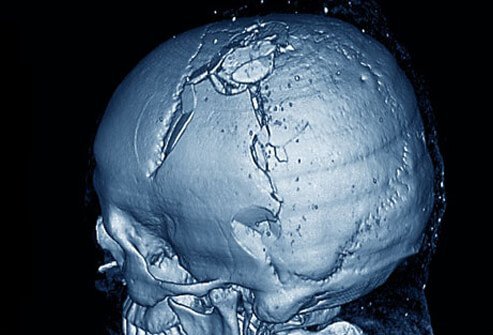 Although the skull is like a helmet that protects the brain tissues, it can be cracked, dented, and penetrated with enough force.