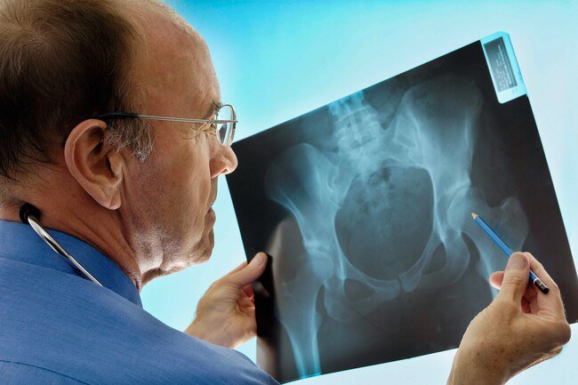 Women are more likely to get osteoporosis and the condition is often overlooked in men.
