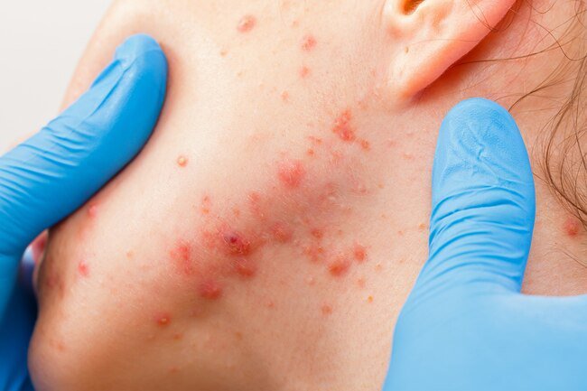 Women are more prone to acne than men due to fluctuating hormone levels.