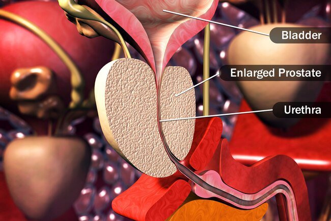 Visible blood in the urine may be one symptom of a swollen prostate.