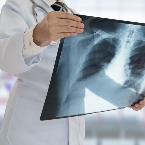 X-Ray Lung Exam