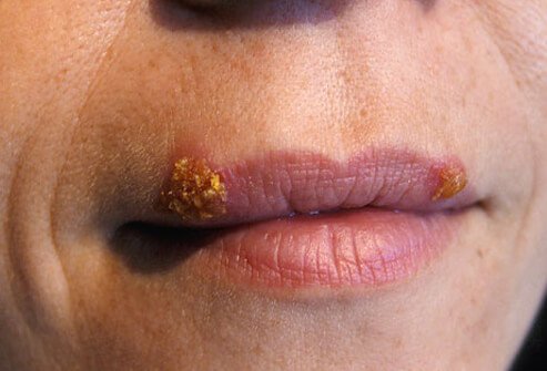 Cold sores Cold sores