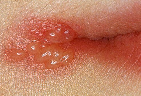 Cold sores Cold sores