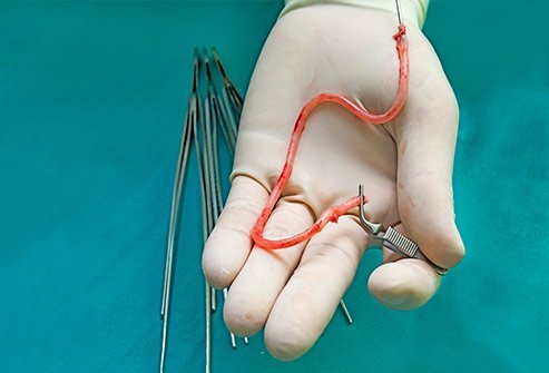 Coronary artery bypass grafting (CABG)