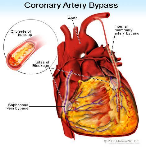 Picture of coronary artery bypass