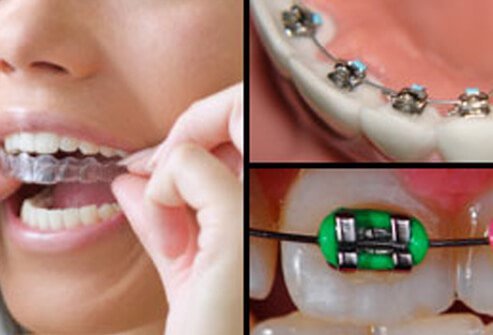 Brackets are the part of braces that are attached to the teeth.