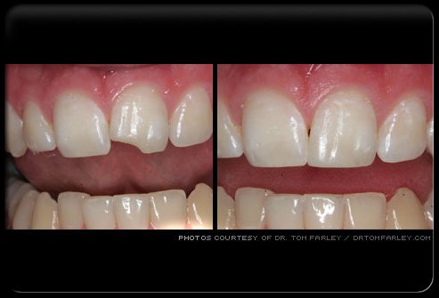 Dental bonding involves the application of a resin to a tooth and then bonding, or hardening, the resin using a special type of light source.