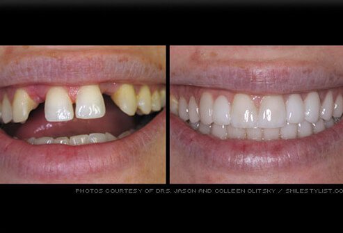 A fixed dental bridge is a permanent structure that replaces one or more teeth.
