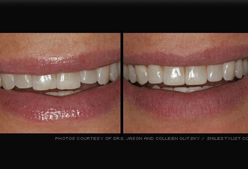 Enamel shaping is a procedure done to correct small irregularities like uneven teeth or slightly crowded teeth.
