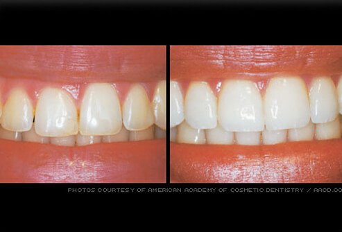 Gum reshaping can be done to improve a smile if the gum line is irregular or if the teeth appear too short.
