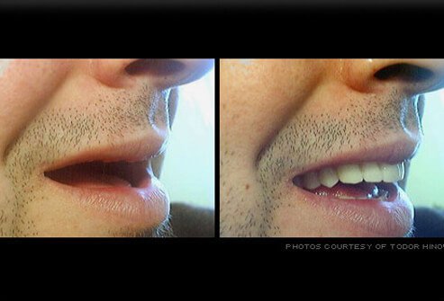 Dentures are removable replacements for missing teeth.
