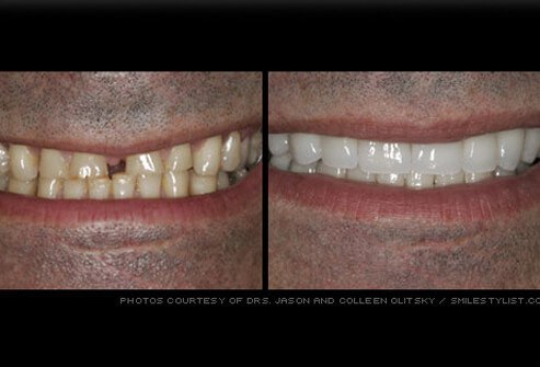 Veneers are thin shells that are applied to cover the front surfaces of teeth.