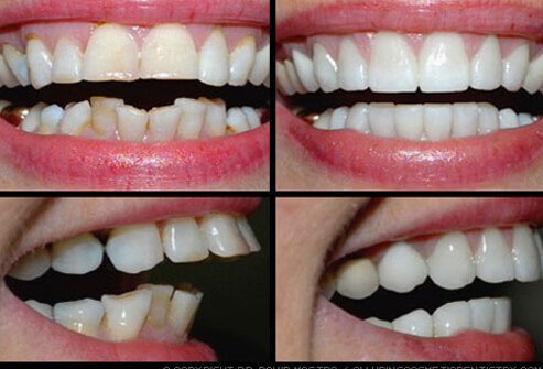 Cosmetic dentistry techniques are often used in combination for a complete smile makeover.