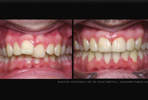 Applying orthodontics (braces) can correct improperly aligned teeth.