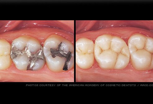 Natural, tooth-colored composite fillings are less obvious than older silver amalgam fillings.