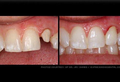 A crown is a type of cap placed over a damaged tooth.