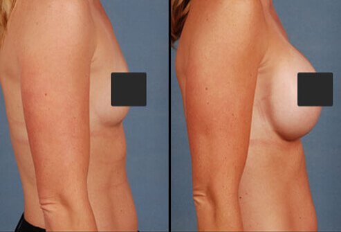 Breast augmentation