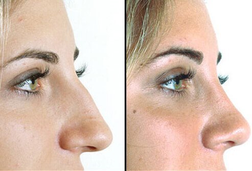 A rhinoplasty (commonly termed a nose job) is a procedure in which the nose is reshaped to correct crookedness, or remove a bump or lump, or simply reduced in size to better fit the facial structure.