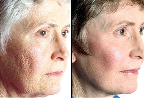 Loose tissue around the neck (sometimes referred to as turkey neck) can be surgically corrected by removing excess skin and tightening the muscles.