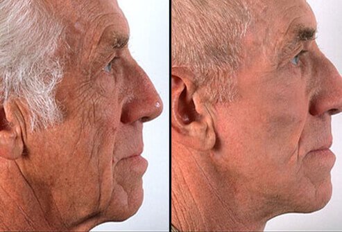 A facelift may reduce the effects of aging and gravity on the facial and neck skin by pulling it upward surgically and removing excess skin, fat, and wrinkles. 