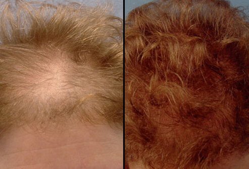Hair loss is common in men and some women as they age. 