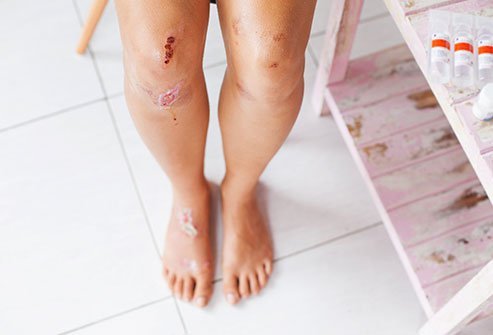 Picture of a woman with cuts, scrapes (abrasions), and wound.