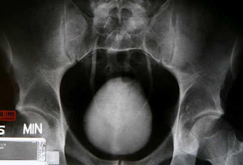 Usually, cystogram is not a painful procedure