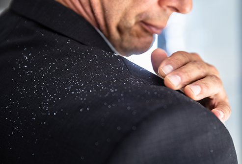 Dandruff, or scalp seborrhea, is often caused by a fungus, but also can have autoimmune or other origins. Dandruff, or scalp seborrhea, is often caused by a fungus, but also can have autoimmune or other origins.