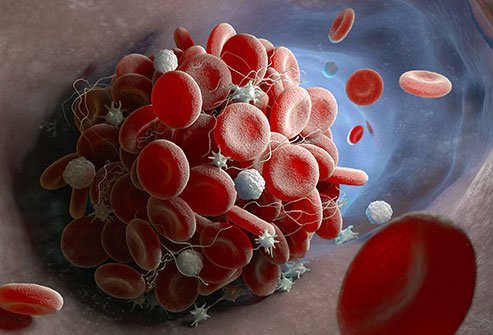 Depending on the location of the thrombus or blood clot, thrombosis may include pain and warmth in the area of the clot, or chest pain and difficulty breathing if the clot is near the lungs, among other symptoms. Depending on the location of the thrombus or blood clot, thrombosis may include pain and warmth in the area of the clot, or chest pain and difficulty breathing if the clot is near the lungs, among other symptoms.