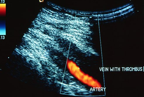 Deep vein thrombosis is a blood clot that forms inside a vein, usually deep within your leg.