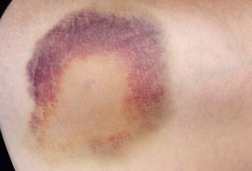 People who take these medications may get bruises often or bleed more easily.