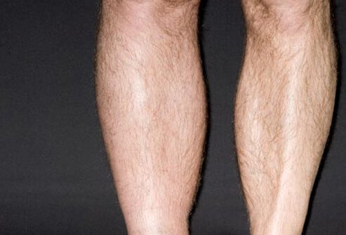 A common symptom of DVT is a leg swollen below the knee.
