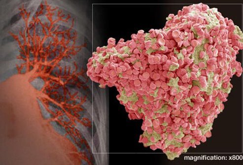 This is a clot that moves into your lungs and blocks the blood supply.