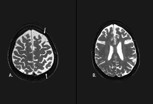 Diffuse asymmetric (L > R) bilateral frontoparietal atrophy (arrows) in a 54-year-old woman with progressive nonfluent aphasia and mild parkinsonism due to pathology-proven corticobasal degeneration.