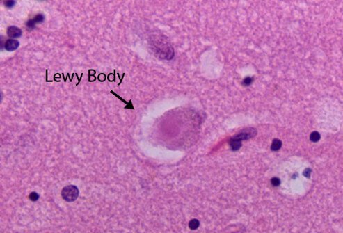 Lewy bodies are made up of a protein called alpha-synuclein.