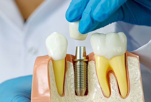 Dental implants are a costly procedure and may not always be covered by insurance providers.