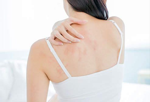 Atopic dermatitis