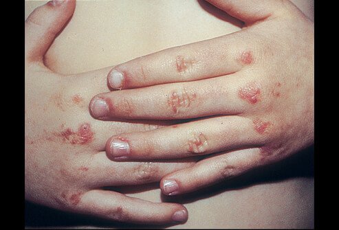Picture of Dermatomyositis