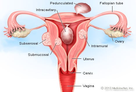 Picture of Uterine Fibroids