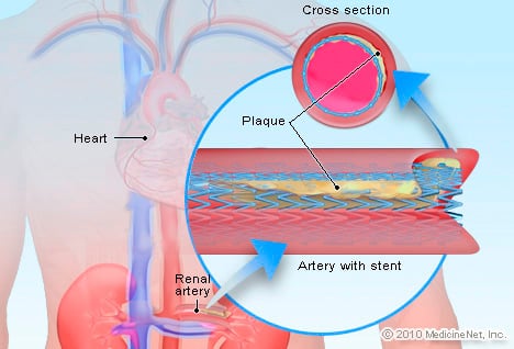 Picture of Renal Artery Stenosis