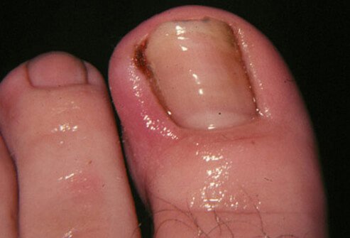 Ingrown toenails derive their name from growing into the skin along the edges of the nail.