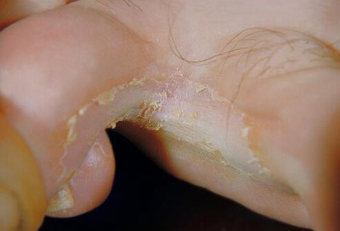 Picture of Athlete's Foot (2 of 2)